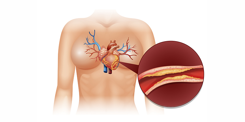 Alteraciones del colesterol